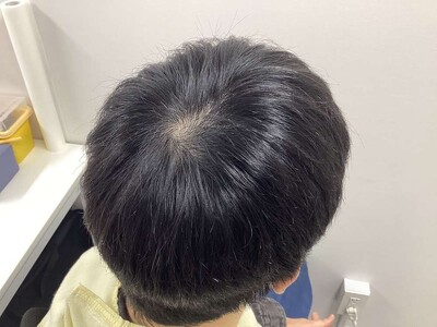 ヘアアートメイク｜20代｜2回の症例写真[ビフォー]
