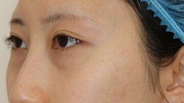 すなおクリニックの目元・クマ・眉下・涙袋整形の症例写真[ビフォー]