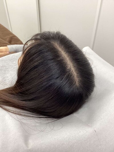 ヘアアートメイク｜20代｜2回の症例写真[ビフォー]
