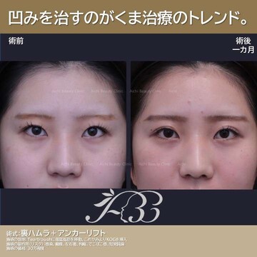 あいちビューティークリニック栄本院の目元・クマ・眉下・涙袋整形の症例写真