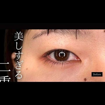 PRISM Beauty Clinicの二重の症例写真[ビフォー]