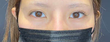 東京美容医療クリニックの目・二重整形の症例写真[ビフォー]