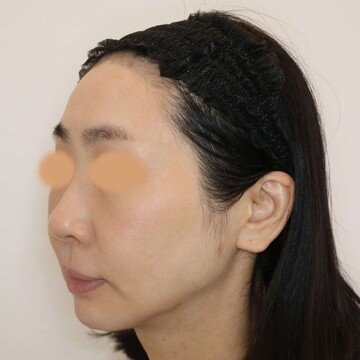 すなおクリニックのしわ・たるみ整形(注入、糸、フェイスリフト)の症例写真[ビフォー]