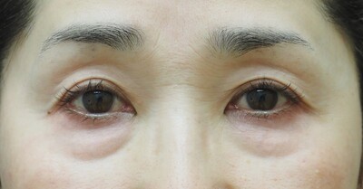 下まぶたのたるみ⼿術（表ハムラ法）の症例写真[ビフォー]