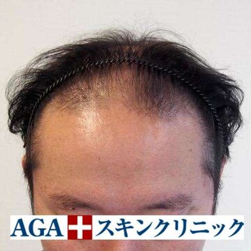 AGAスキンクリニックの薄毛治療の症例写真[ビフォー]