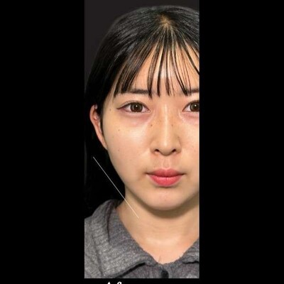 脂肪吸引＋3DEライン＋糸リフトの症例写真[アフター]