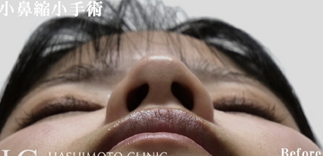 静岡美容外科橋本クリニックの鼻の整形の症例写真[ビフォー]