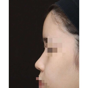 聖心美容クリニックの鼻の症例写真[ビフォー]