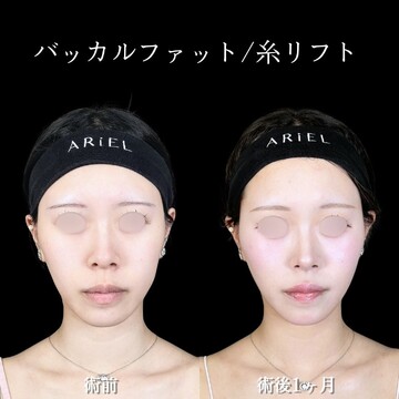 アリエル美容クリニック 大宮院の脂肪吸引の症例写真