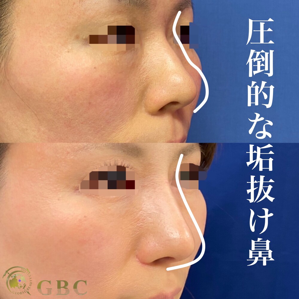 術前 術後3ヶ月 鼻の整形の症例写真 画像 グローバルビューティークリニック 大阪院 Cs699 美容医療の口コミ広場 術前 術後3ヶ月 鼻の整形の症例写真 画像 グローバルビューティークリニック 大阪院 Cs699 美容医療の口コミ広場