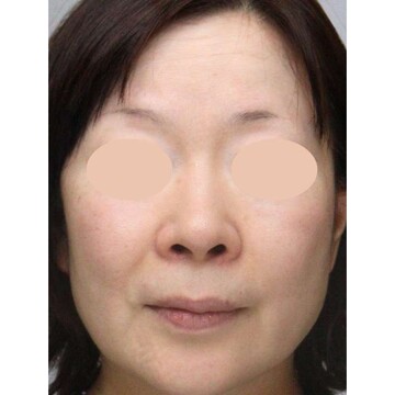 聖心美容クリニックの鼻の症例写真[ビフォー]