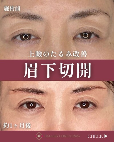 上瞼のたるみ改善 眉下切開の症例写真