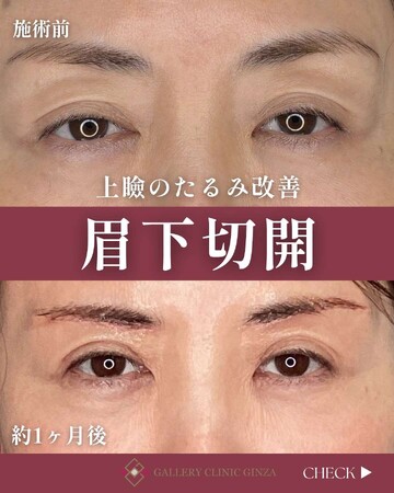 ギャラリークリニックの目元・クマ・眉下・涙袋整形の症例写真