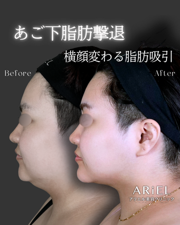 アリエル美容クリニック 郡山院の脂肪吸引の症例写真