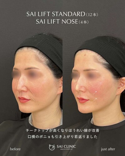 糸リフト（SAI LIFT STANDARD）＋ 鼻糸リフトの症例写真