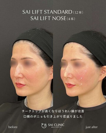 SAI CLINIC （サイクリニック）のリフトアップの症例写真