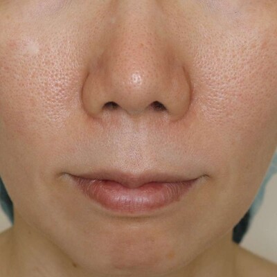 人中短縮の症例写真[ビフォー]