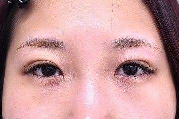 医療法人秀晄会 心斎橋コムロ美容外科クリニックの症例写真[アフター]