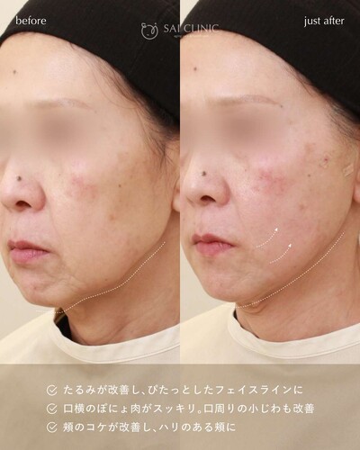 糸リフト（SAI LIFT PERFECT）18本の症例写真