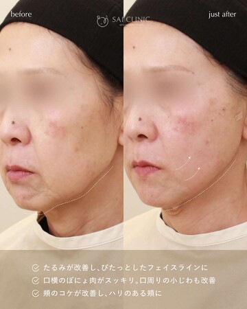 SAI CLINIC （サイクリニック）のリフトアップの症例写真