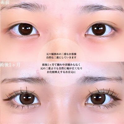 アリエルクイックループダブル二重埋没法の症例写真