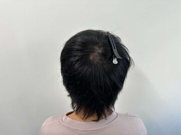 AGAスキンクリニックのアートメイクの症例写真[ビフォー]