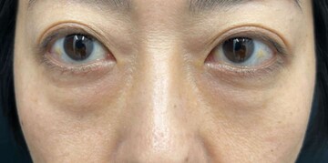 AI Beauty Clinicの目元・クマ・眉下・涙袋整形の症例写真[ビフォー]