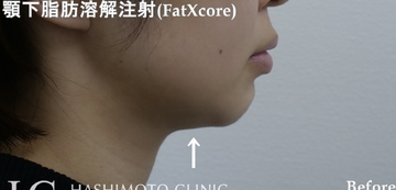 静岡美容外科橋本クリニックの輪郭・顎・エラ・額・小顔整形の症例写真[ビフォー]
