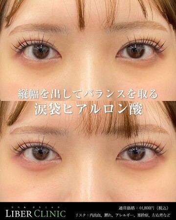LIBER CLINIC （リベルクリニック）の目元・クマ・眉下・涙袋整形の症例写真