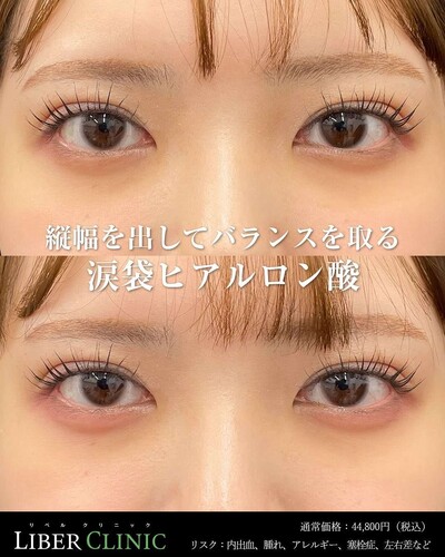 涙袋ヒアルロン酸の症例写真