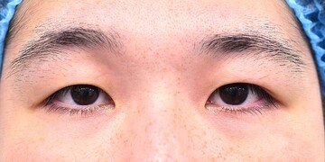 医療法人秀晄会 心斎橋コムロ美容外科クリニックの目・二重整形の症例写真[ビフォー]