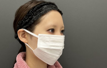 Plume Clinicのしわ・たるみ整形(注入、糸、フェイスリフト)の症例写真[ビフォー]