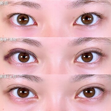 アリエル美容クリニック 大宮院の目・二重整形の症例写真