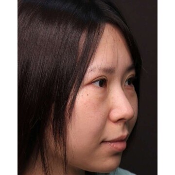 聖心美容クリニックの目元の症例写真[ビフォー]