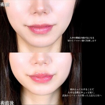 アリエル美容クリニック 大宮院の口元・唇の整形・人中短縮の症例写真