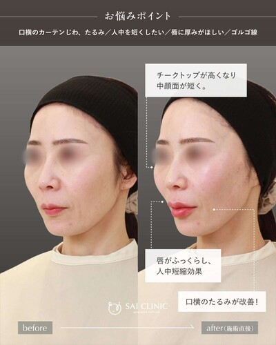 SAI LIFT STANDARD と 唇ヒアルロン酸の症例写真