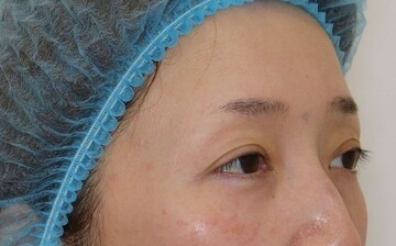 すなおクリニックの目元・クマ・眉下・涙袋整形の症例写真[ビフォー]