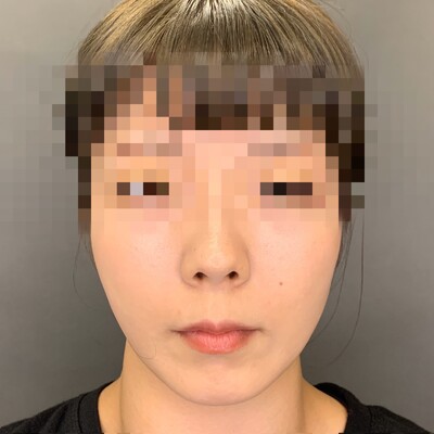 小顔整形 シャープな小顔に 顎の整形 ヒアルロン酸注入 輪郭 顎 その他 輪郭整形 エラ 小顔ボトックスの症例写真 画像 Tcb東京中央美容外科 渋谷西口院 Cs 美容医療の口コミ広場