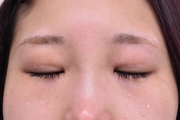 医療法人秀晄会 心斎橋コムロ美容外科クリニックの症例写真[アフター]