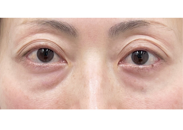 AI Beauty Clinicの目元・クマ・眉下・涙袋整形の症例写真[ビフォー]