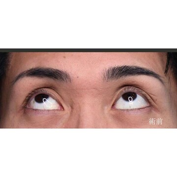 聖心美容クリニックの二重の症例写真[ビフォー]