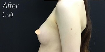 豊胸 胸の整形の症例写真 画像 美容医療の口コミ広場