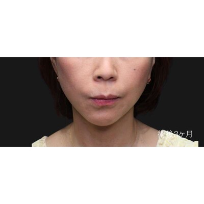他院フェイスリフト後の再リフトでさらにシャープにの症例写真[アフター]