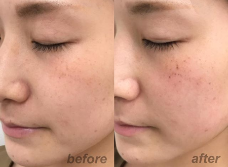 シミ治療 イープラス シミ取り 肝斑 毛穴治療の症例写真 画像 銀座mitaクリニック Cs 美容医療の口コミ広場