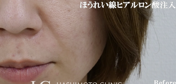 静岡美容外科橋本クリニックのしわ・たるみ整形(注入、糸、フェイスリフト)の症例写真[ビフォー]