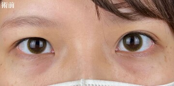 AI Beauty Clinicの二重の症例写真[ビフォー]