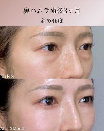裏ハムラの症例写真