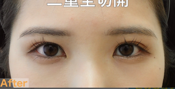 さかえ皮フ科クリニック（旧：ニドークリニック名古屋）の症例写真[アフター]