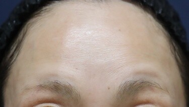 しわボトックス（額）の症例写真[アフター]