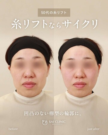 SAI CLINIC （サイクリニック）のリフトアップの症例写真